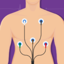 Electrical Cardioversion