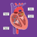 Cardiac Ablation