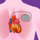 Pacemaker Implantation